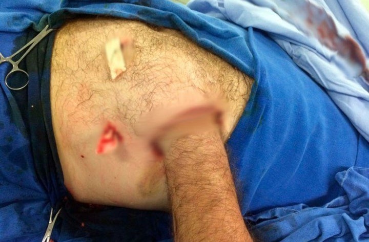 Carlos Mariotti lost both his fingers and all the skin from his hand.
