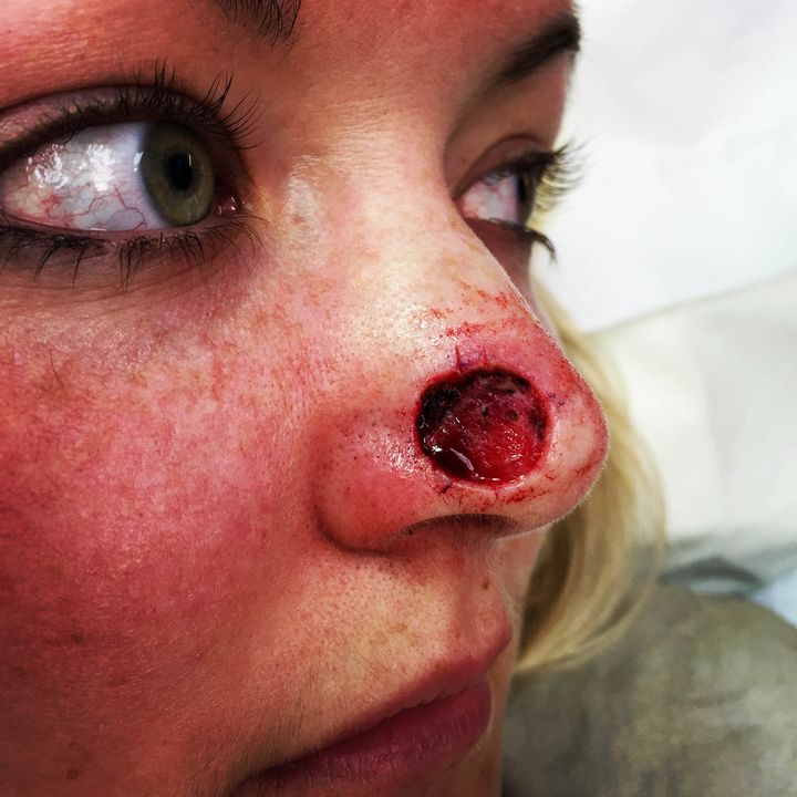 Jade was left with a coin-sized hole in her nose after having the cancer removed.