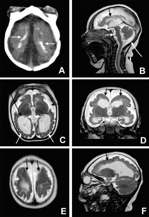 Scans show brain abnormalities including calcifications (A), nerve abnormalities (B), enlarged brain cavities (C) and thickness in the frontal lobe (D, E and F). 
