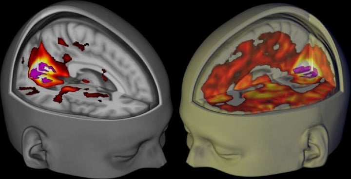 Researchers at Imperial College London compared fMRI scans of the brain on LSD (right) with scans of the brain on a placebo (left).