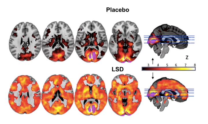 Researchers at compared fMRI scans of the brain on LSD to the brain scans of people who'd received a placebo. The top row of images show normal brain activity with a placebo; the bottom row of images depict brain activity while hallucinating on LSD.