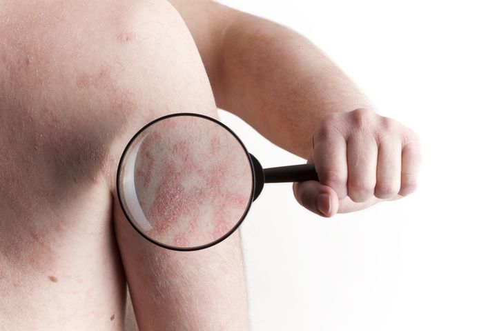 There could be a connection between psoriasis and cardiovascular health.