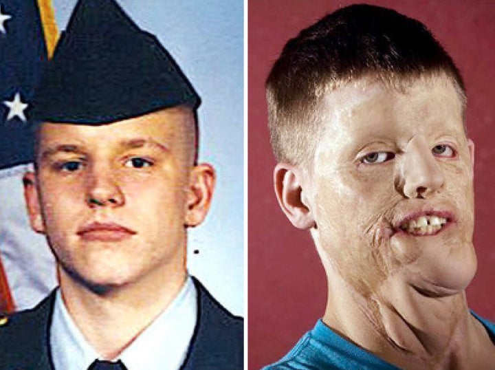 Mitch Hunter before and after the accident. 