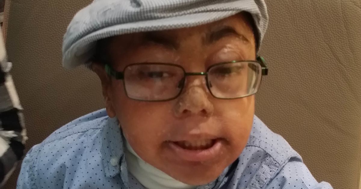 Parents Hope To Raise Awareness Of Son's Rare Skin Condition: 'People ...