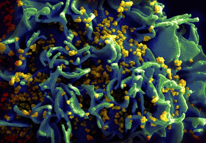 Treating a parasitic worm infection could help cut down on the spread of HIV. Pictured: HIV viruses infecting a human T-cell. 
