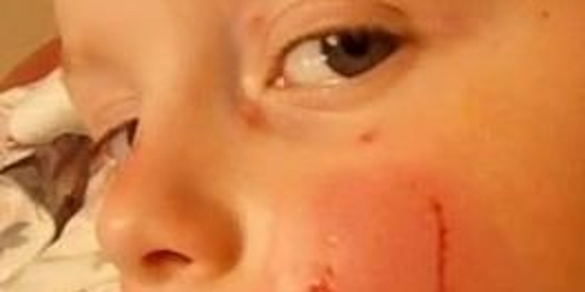 Family Share Shocking Image Of Toddler's Injuries To Warn Of Dog Attack
