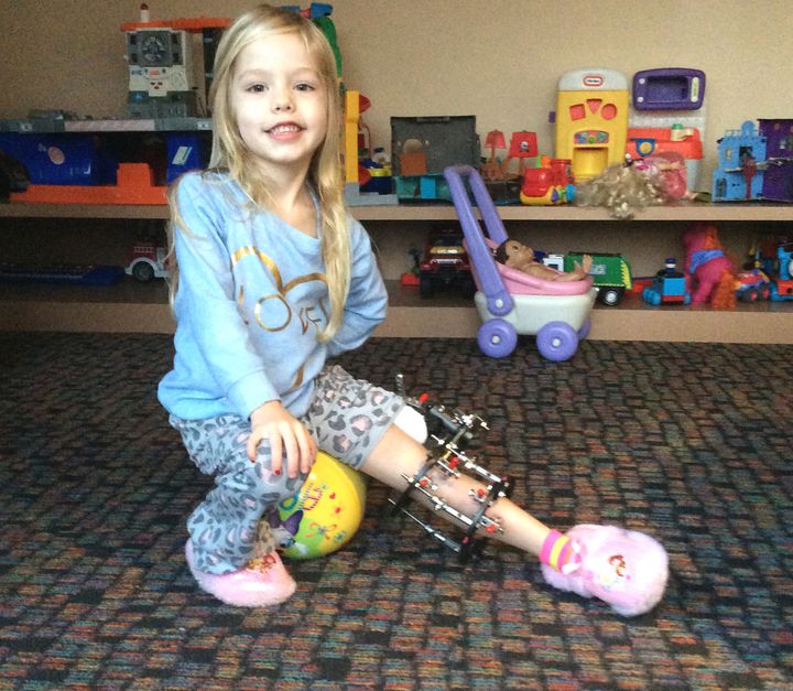 Parents 'Choose To Break' Daughter's Leg Three Times A Day To Avoid ...