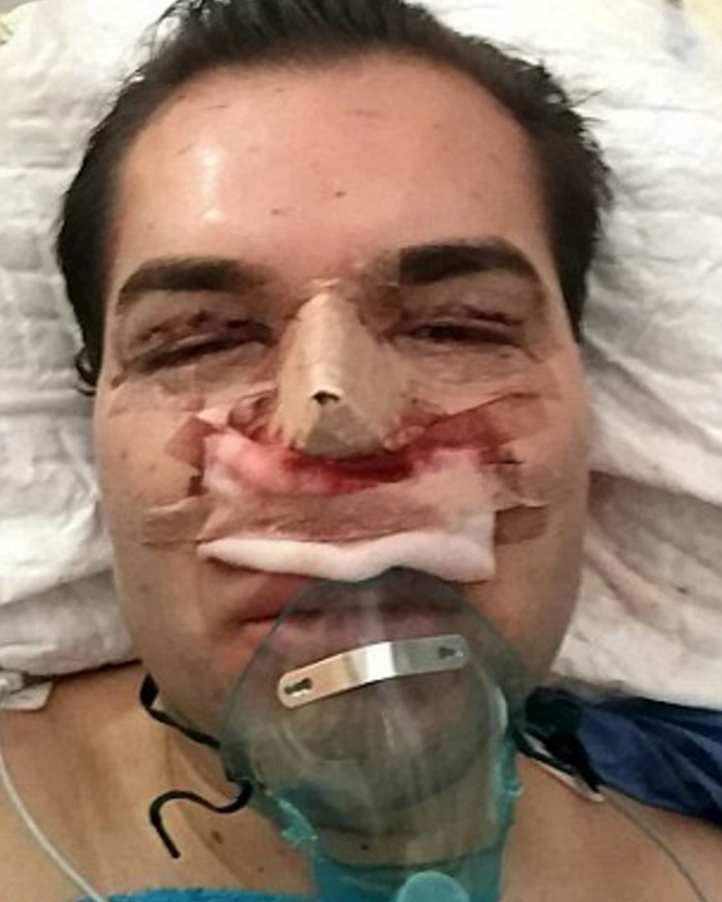 The surgery left Alves unable to breathe properly