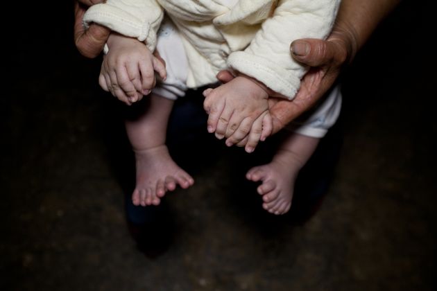 指が31本ある赤ちゃんが中国で生まれた 画像 ハフポスト