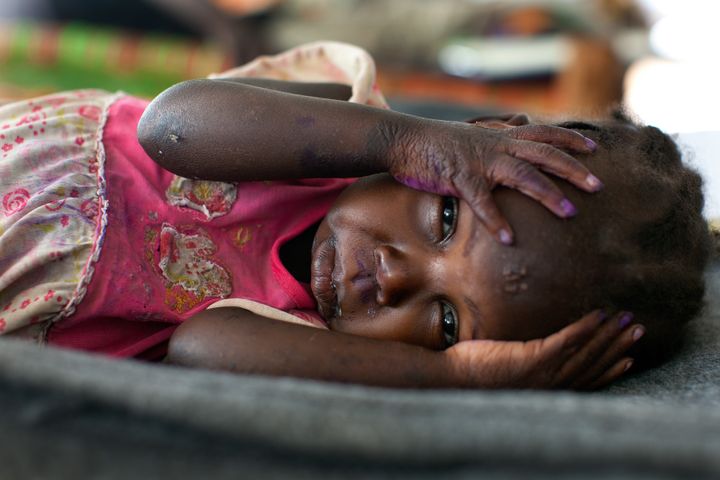 A child lays in a hospital bed suffering from painful skin infections and malnourishment at a hospital inside the Yida refugee camp along the border with North Sudan in South Sudan.