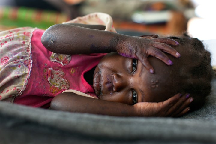 A child lays in a hospital bed suffering from painful skin infections and malnourishment at a hospital inside