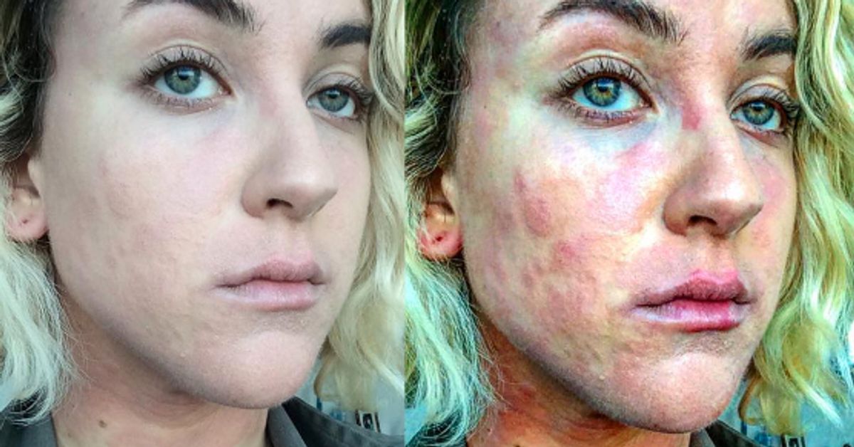 Woman With Psoriasis Shows What Its Really Like Living With The Skin