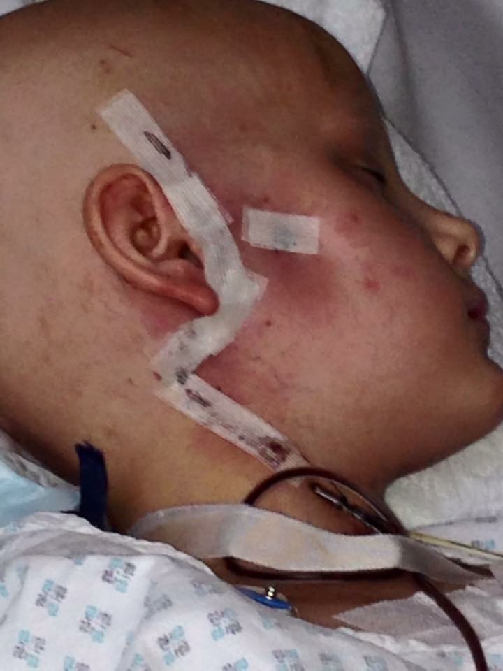 Emma shortly after surgery.