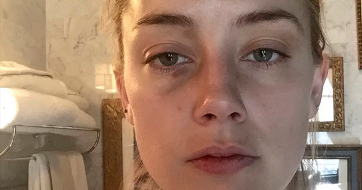 New Photos Supporting Amber Heard’s Abuse Allegations Against Johnny Depp Surface