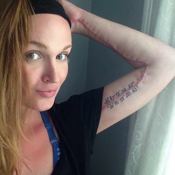 Erin Rhoades thought she had a small bruise when she first noticed the blemish