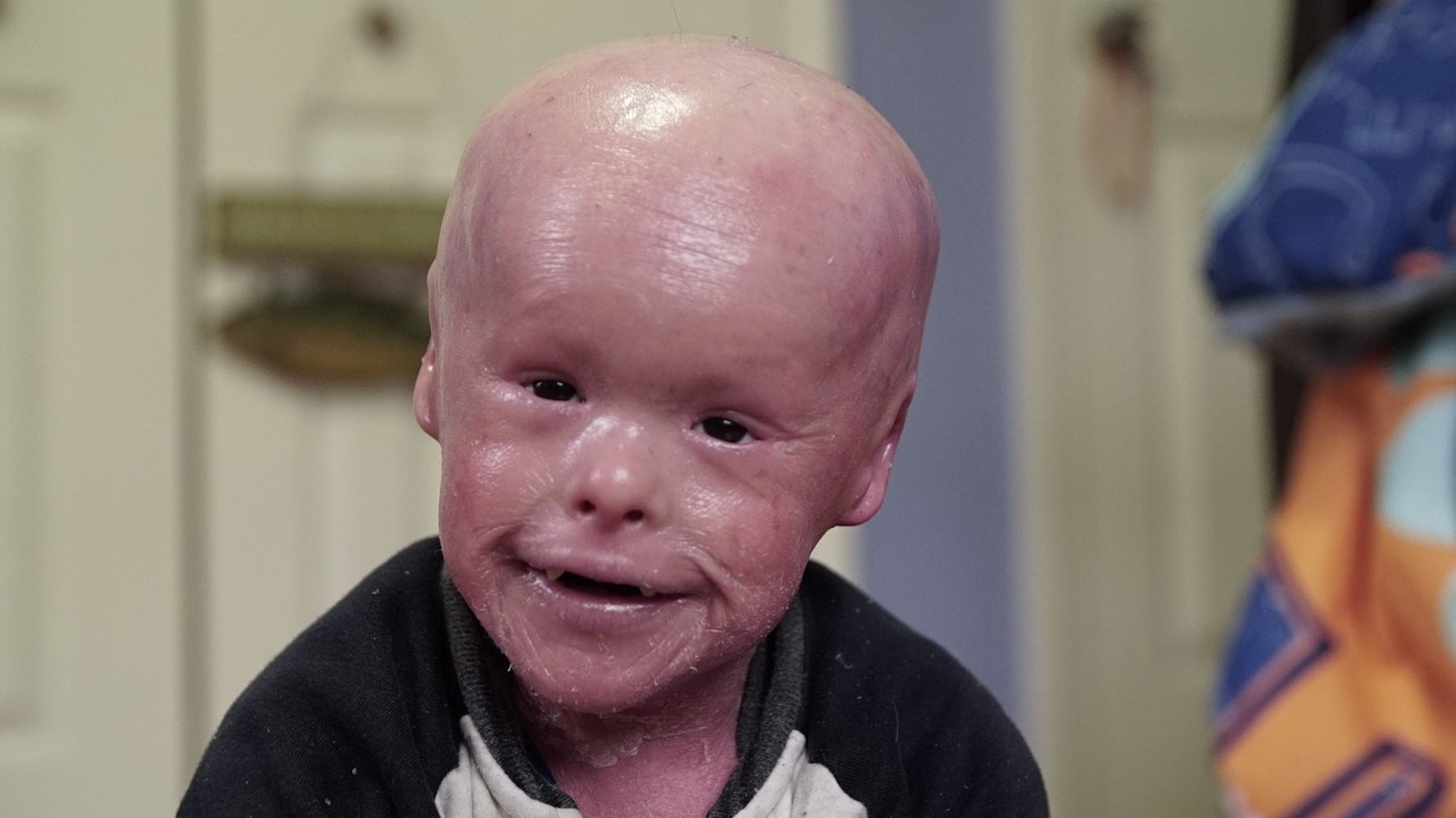 Harlequin Ichthyosis Rare Condition Causes Five Year Old S Skin To At Grow Ten Times The Normal Rate Huffpost Uk Parents