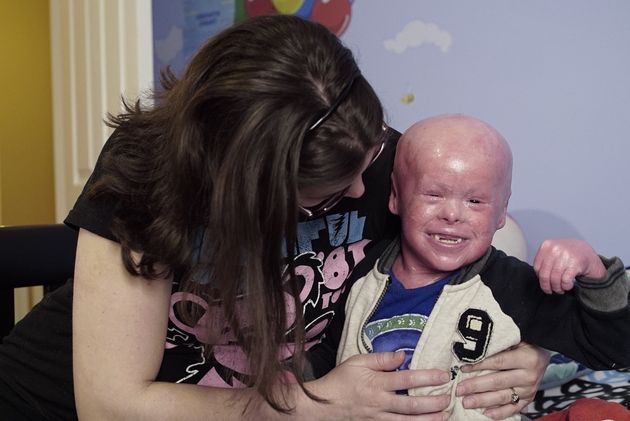 Harlequin Ichthyosis: Rare Condition Causes Five-Year-Old's Skin To At ...