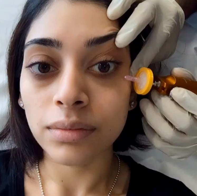 carboxy under eye treatment