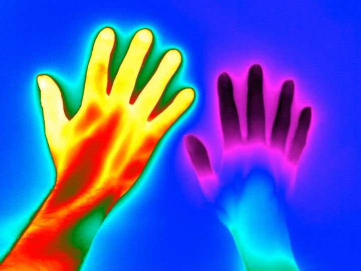 A heat map of two hands - one with Raynaud’s, one without.