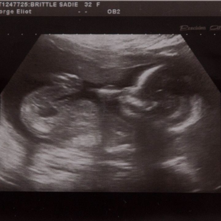 Sadie Brittle's scan at 19 weeks