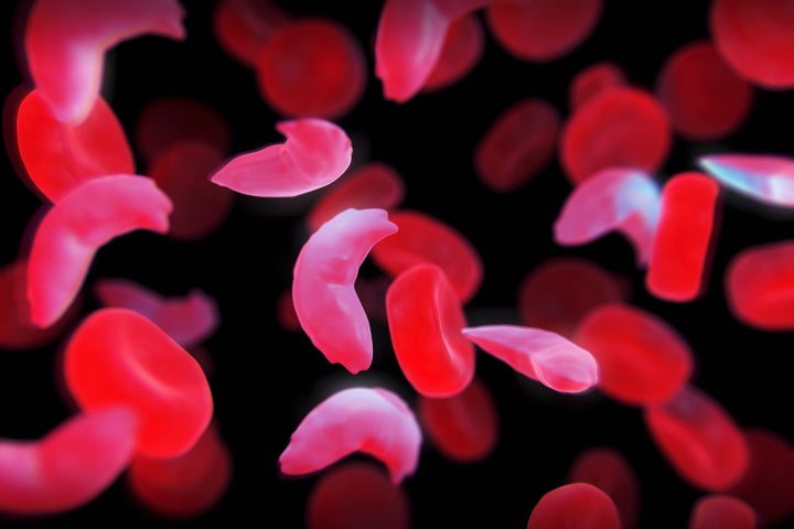 Sickle-cell disease, sickle-cell anaemia or drepanocytosis is a recessive genetic blood disorder characterized by red blood cells that assume an abnormal, rigid, sickle shape. Here healthy blood cells are seen along with diseased cells.