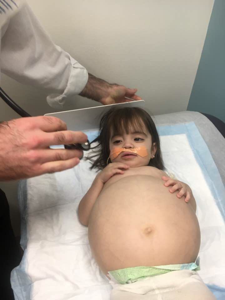 Maddy's large stomach before her transplant