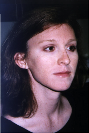 Facial feminization results photo, office of Dr. Douglas Ousterhout, 1997.