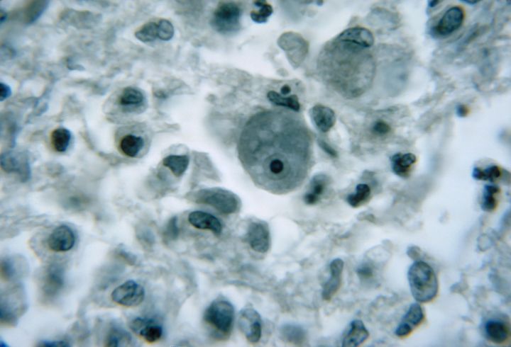 The amoeba can lead to a central nervous system disease called primary amebic meingoencephalitis. An infected brain tissue specimen is seen.