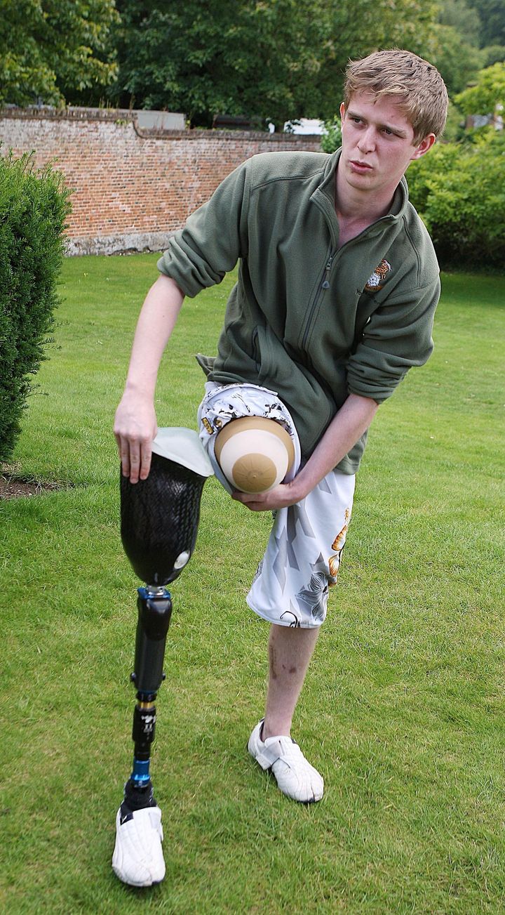 Private Chris Herbert, 19, from the Territorial Army 4th Battalion Yorkshire Regiment shows his injured leg and prosthetic limb to reporters at the Headley Court Rehabilitation Centre on July 18, 2007 near Leatherhead, England. Private Herbert lost his leg when an improvised explosive device (IED) hit his patrol in southern Iraq in February 2007.