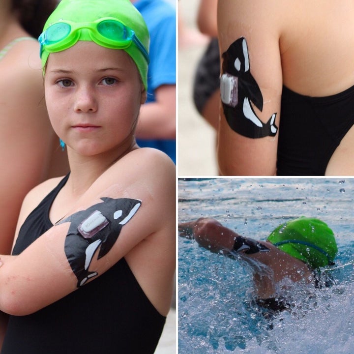 David Engler decorated his daughter Claire's diabetes device for her swim meet. 