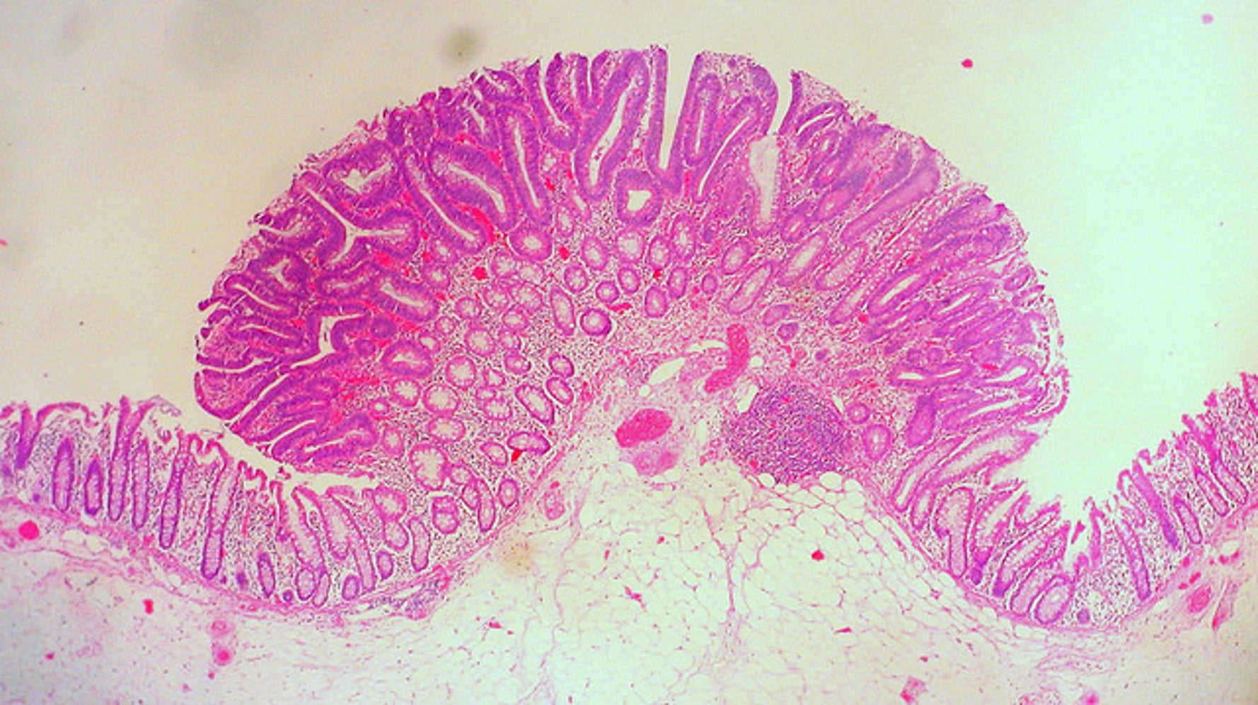 USPSTF on colon cancer “The best screening test is the one that gets