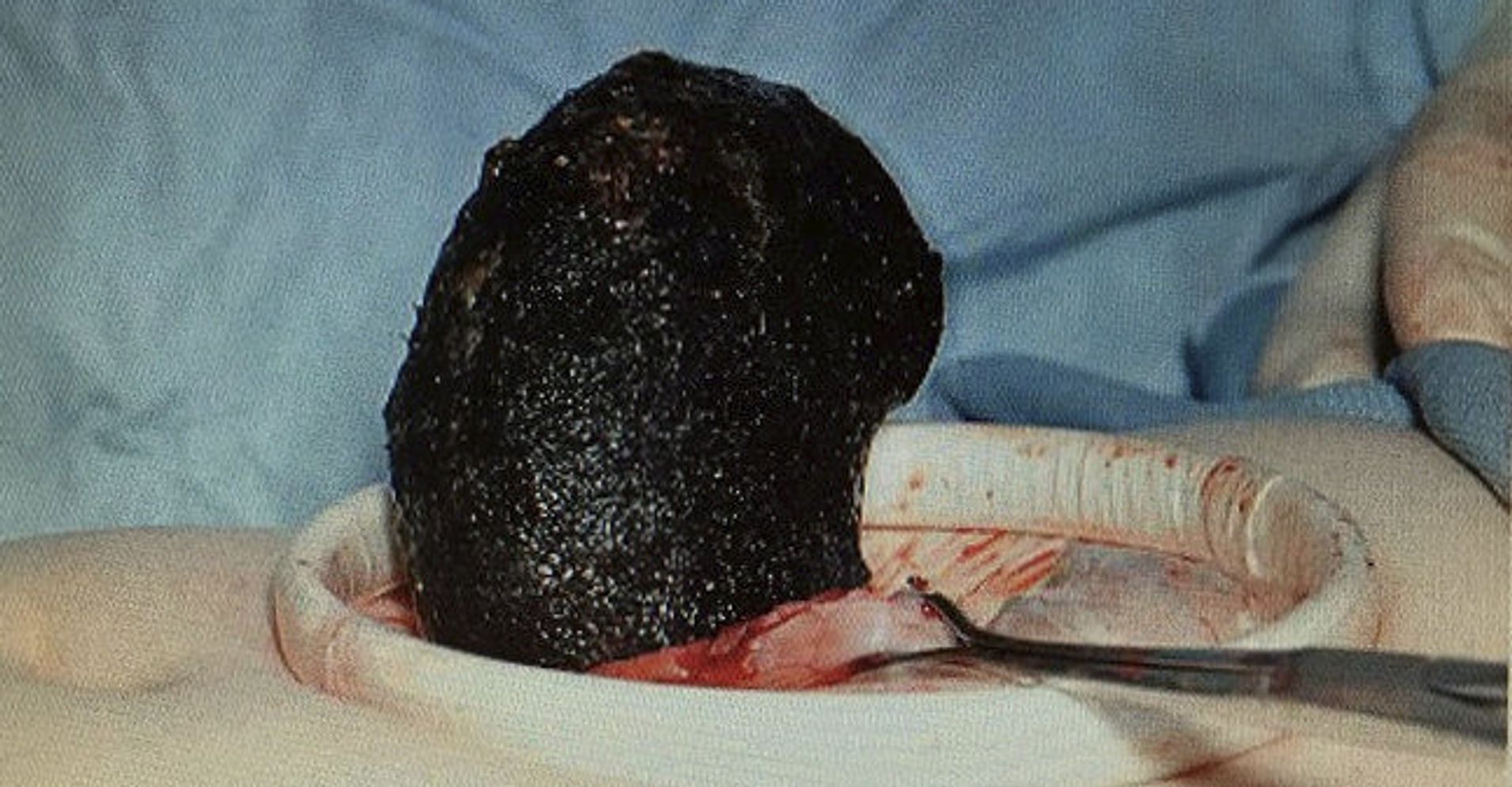 Doctors Remove 14-Pound Hairball From Woman's Stomach ...