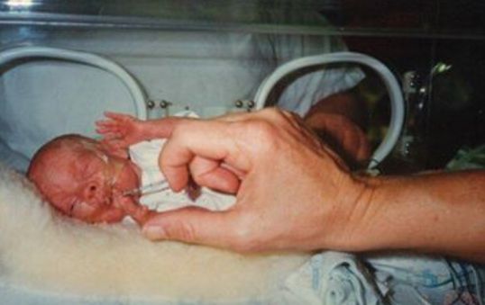 His sister when she was born 15 weeks early. 