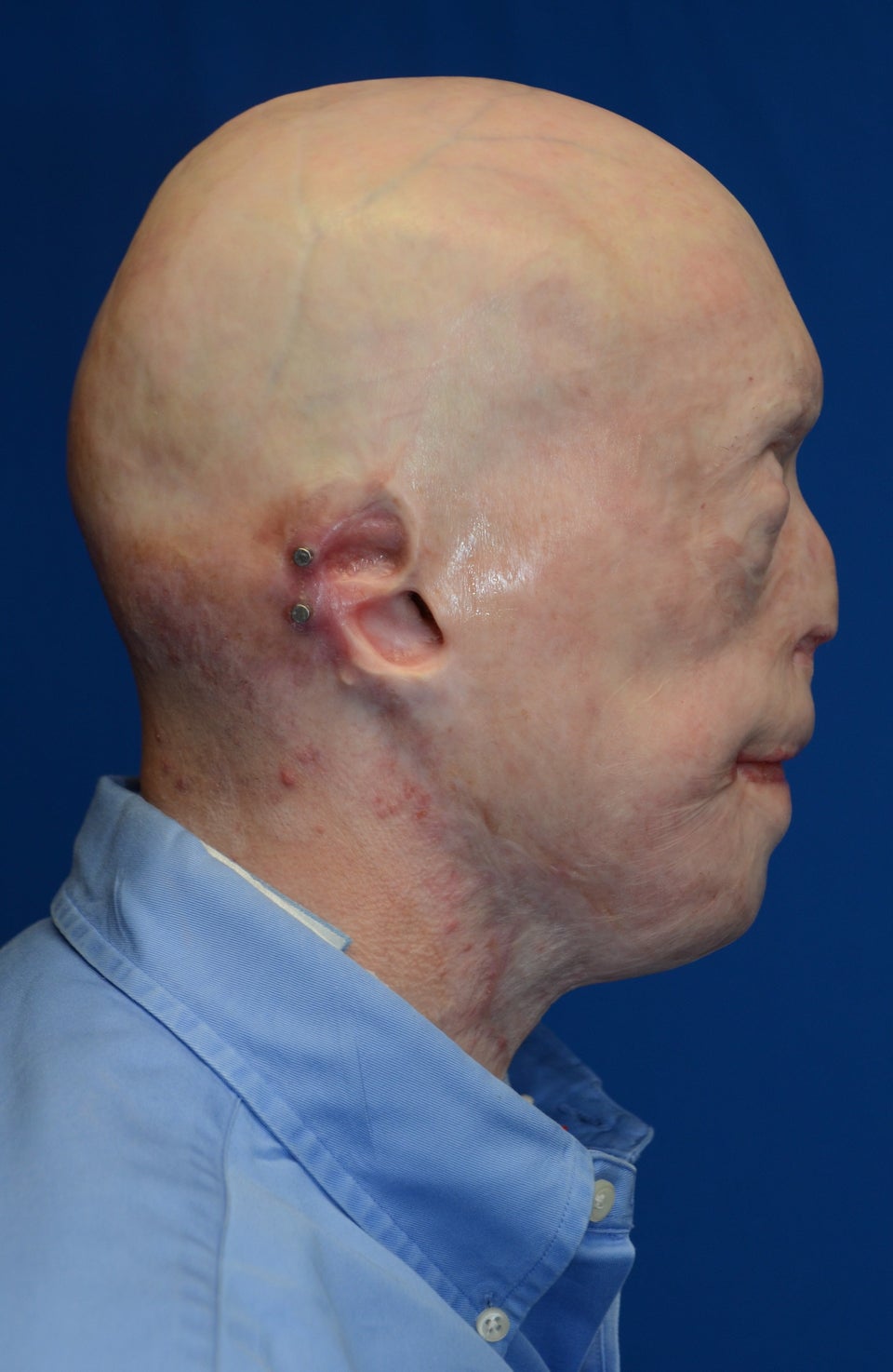 Graphic New Photos Of Face Transplant Show Burn Patient's Remarkable