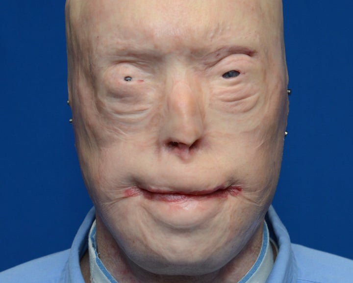 Patrick Hardison before his face transplant surgery.