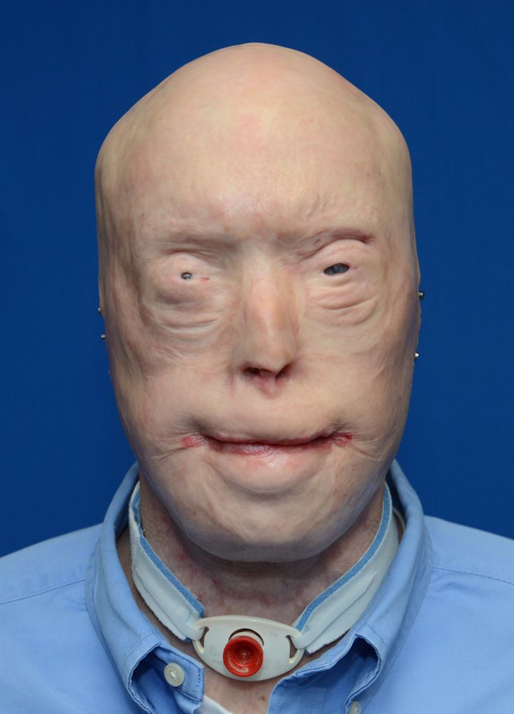Patrick Hardison before his face transplant surgery.