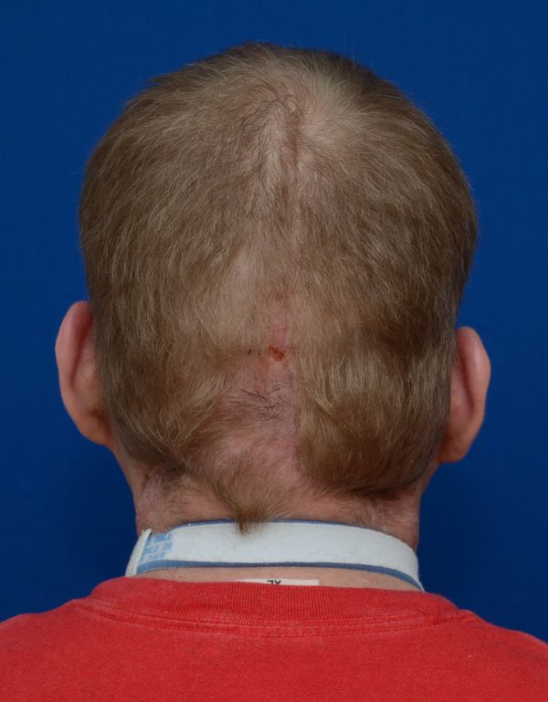 back to how in burn nerves Graphic Photos New Face Burn Show Patient's Of Transplant