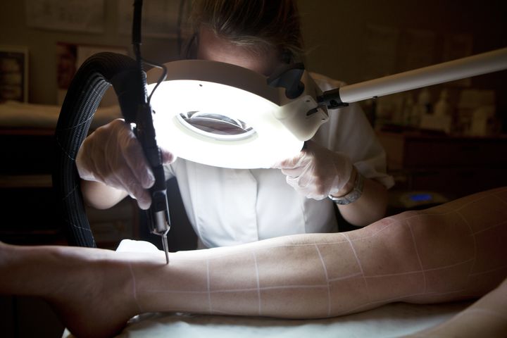 Laser hair removal session in Paris.
