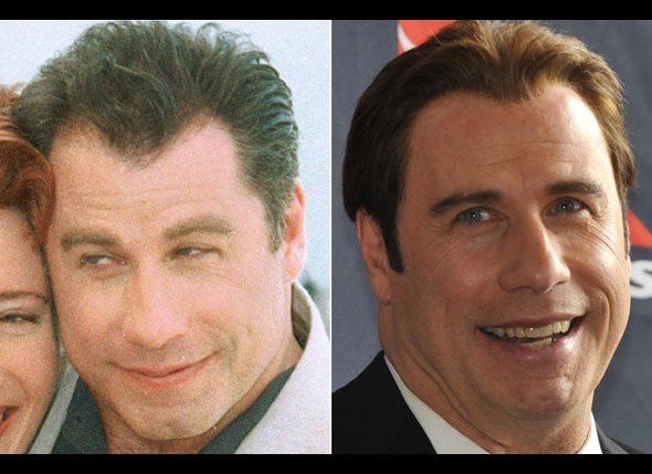 Hair Transplants - John Travolta