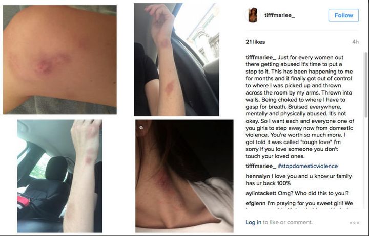 Elliott's girlfriend shows bruises after alleging months of abuse.