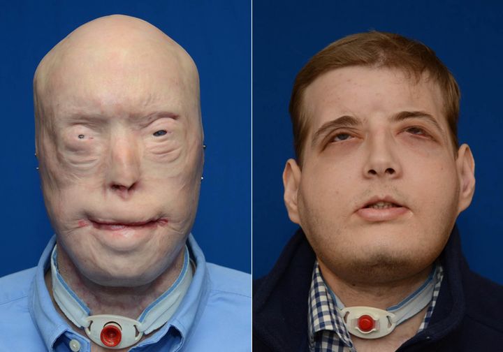 Patrick Hardison prior to his face transplant surgery (left) and in February 2016, about six months after surgery.
