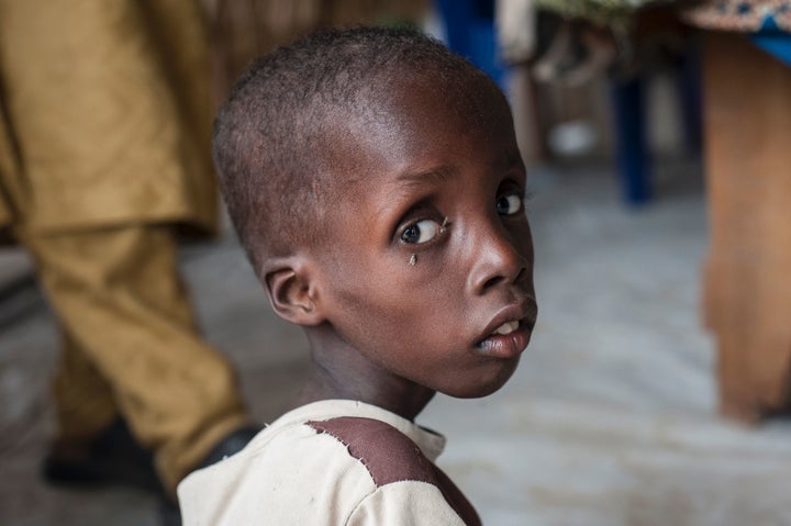 A boy suffering from severe acute malnutrition at one of UNICEF's nutrition clinics in the Muna informal settlement on the outskirts of Maiduguri on June 30.