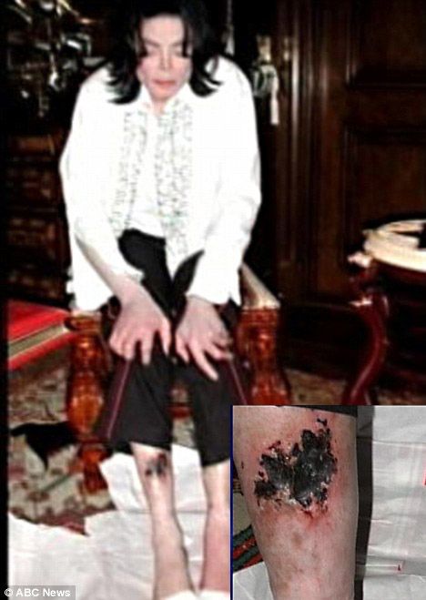The Initial Purpose Of This 2002 Photo Was To Prove The Existence Of A Spider Bite That Had Delayed A Court Appearance. While The Actual Cause Of The Necrosis Shown Here Remains Debatable, The Photo Proved Valuable For Another Reason Entirely-As Proof Of The Splotchy Discoloration Caused By Vitiligo!