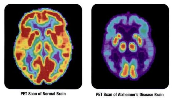 PET scans showing the differences between a normal older adult's brain and the brain of an older adult afflicted with Alzheimer's disease.