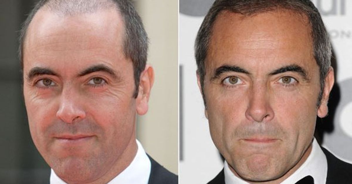 James Nesbitt Credits Hair Transplant With Boosting His Career.