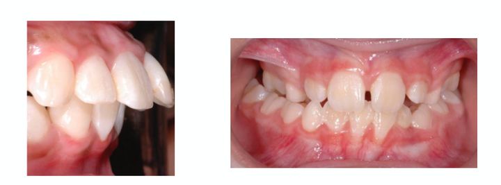 Jaw abnormalities found in children: mandibular retrognathia, enlarged over-jet, lateral crossbite