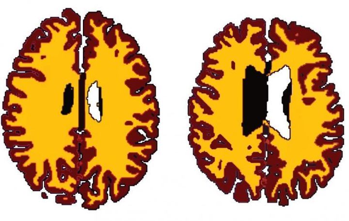 Comparison of grey matter (brown) and white matter (yellow) in gender-matched subjects.