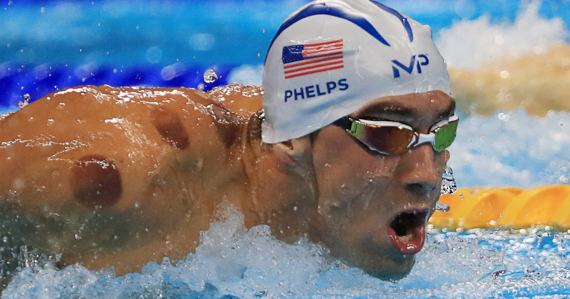 Michael Phelps Swears By Cupping. Should You Try It?