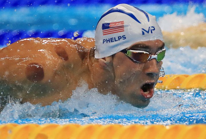 Michael Phelps competes at the Rio Olympics with circular bruises from cupping on his shoulders and back.
