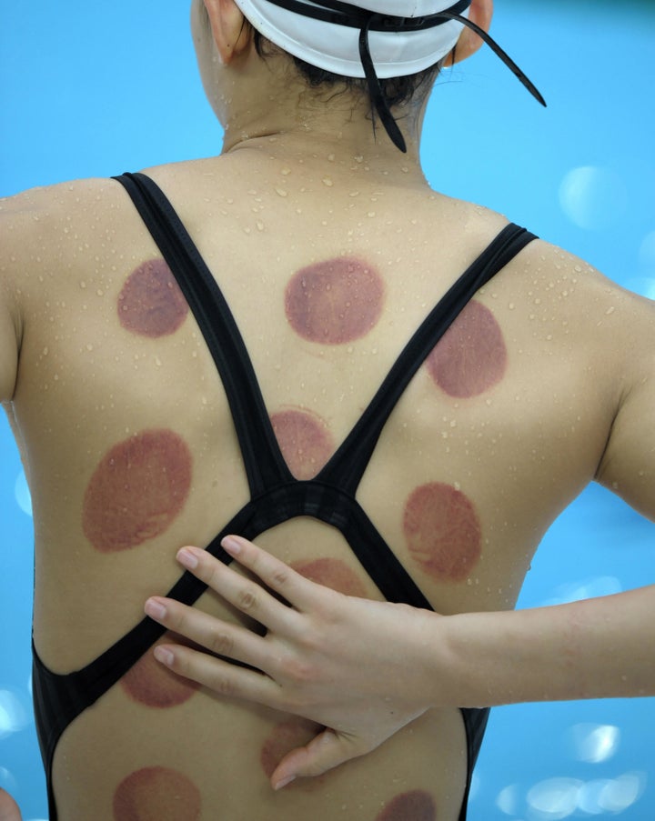 Chinese swimmer Wang Qun was seen with marks from a cupping treatment a few days before the start of the Beijing 2008 Olympic Games.